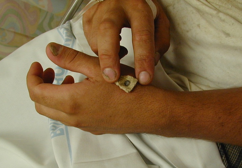Nail-gun-injury-Hand-001-11