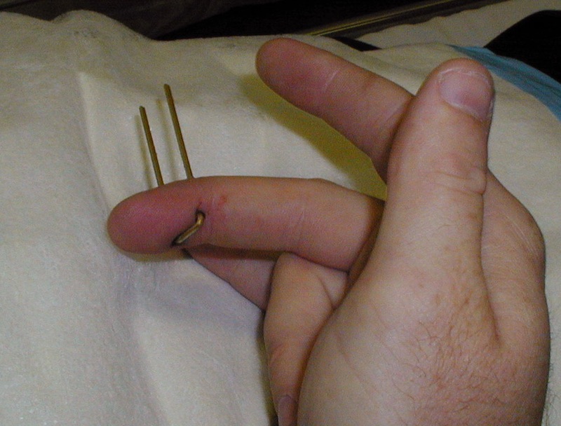 Nail-gun-injury-Hand-002-2