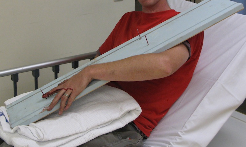 Nail-gun-injury-Hand-003-5