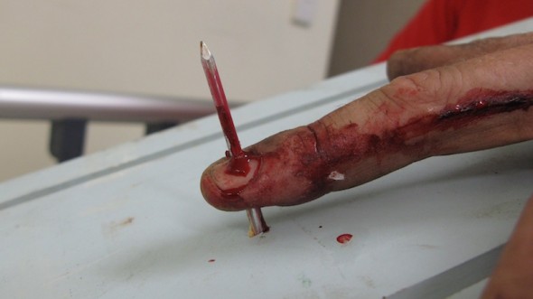 Nail-gun-injury-Hand-003-8-590x331