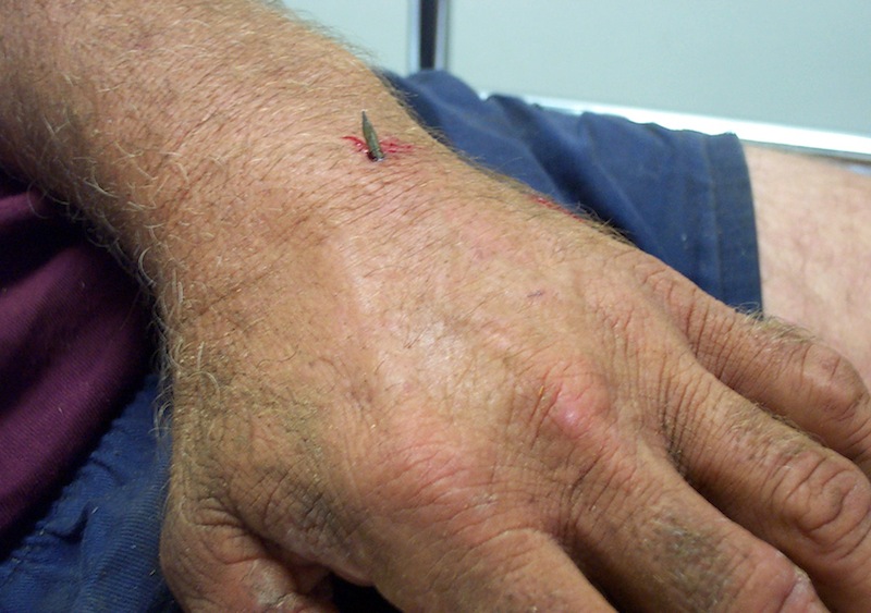 Nail-gun-injury-Hand-004-4