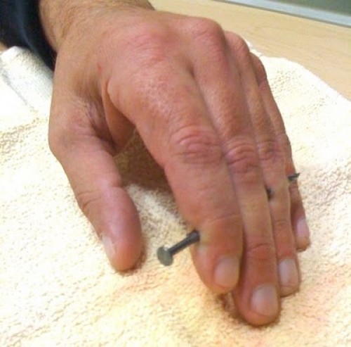 nail-gun-injury1