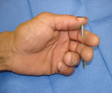 nail-gun-injury2