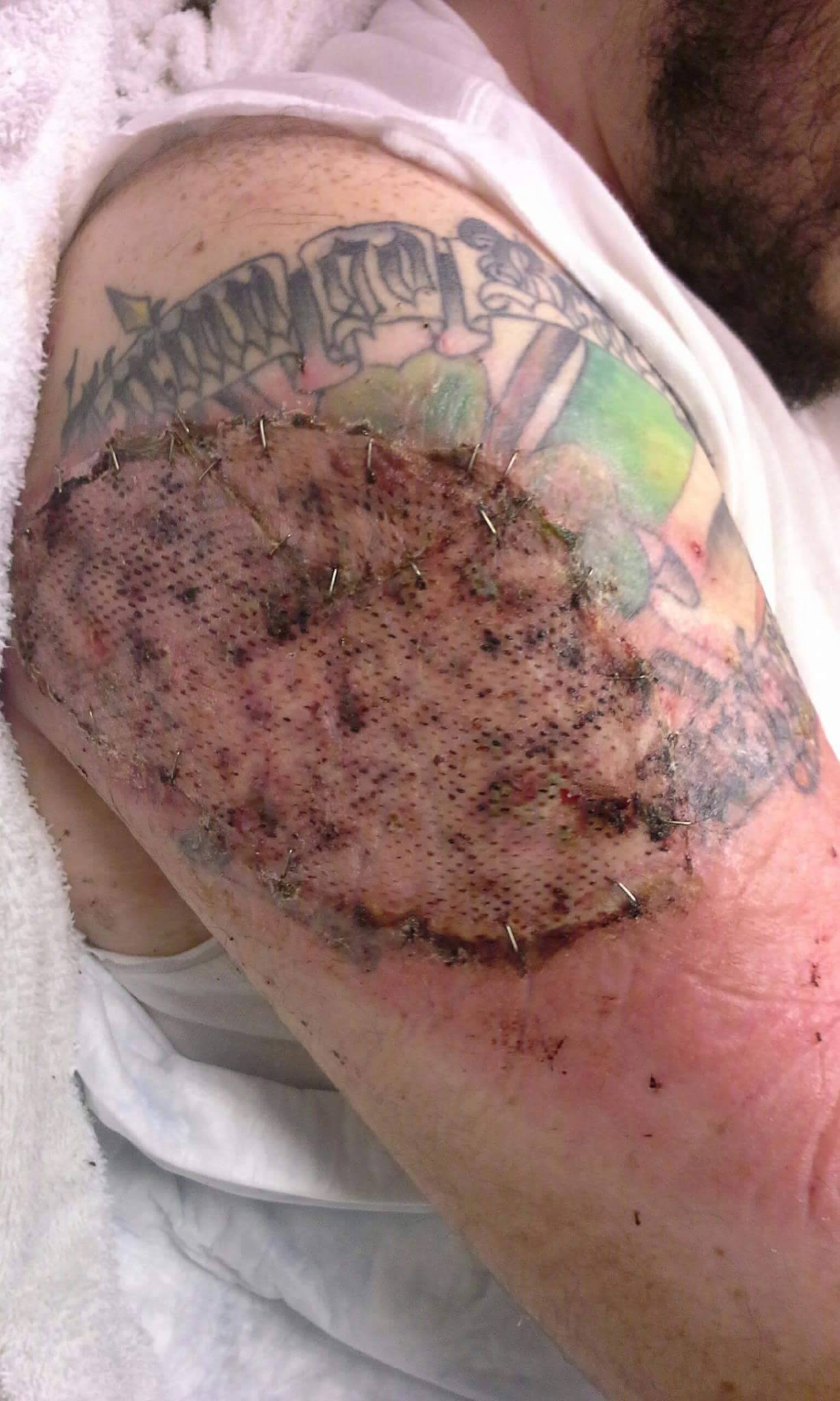arm postskingraft